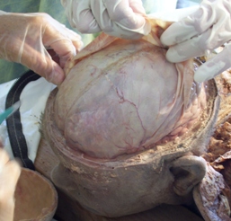 B2: Brain Tissue, Nuclei, Fluid & RAS - Fluid Dynamics and Fascia Release of the CNS